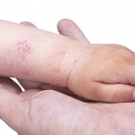 Dermatiti infantili: maggior rischio di asma e allergie alimentari