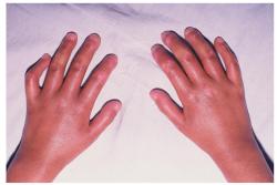 systemic-sclerosis-2