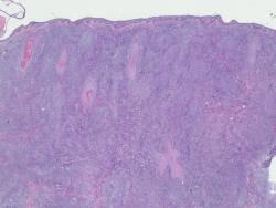 cutaneous-B-cell-lymphomas