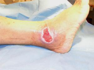 venous-leg-ulcers