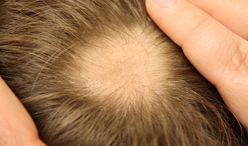 alopecia areata dettaglio