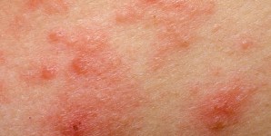 I probiotici riducono la severità della dermatite atopica?