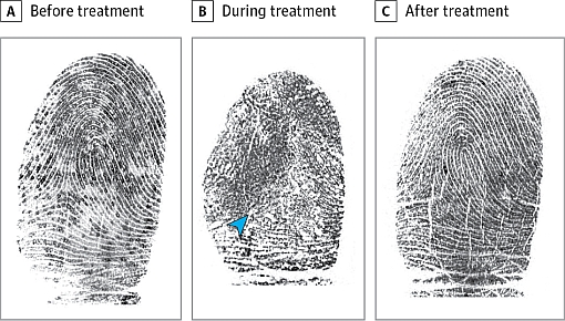 fingerprints capecitabine