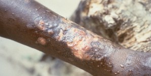 Singola dose di azitromicina efficace contro la framboesia latente